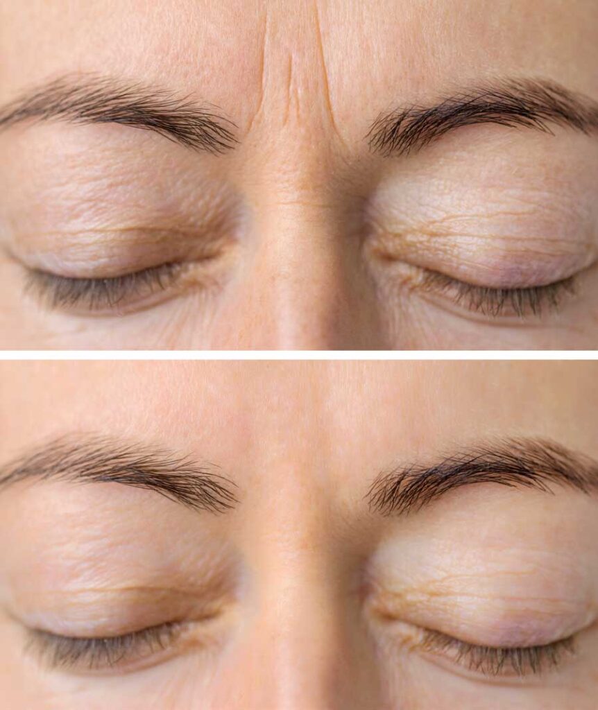 Side-by-side close-up comparison of the eye area