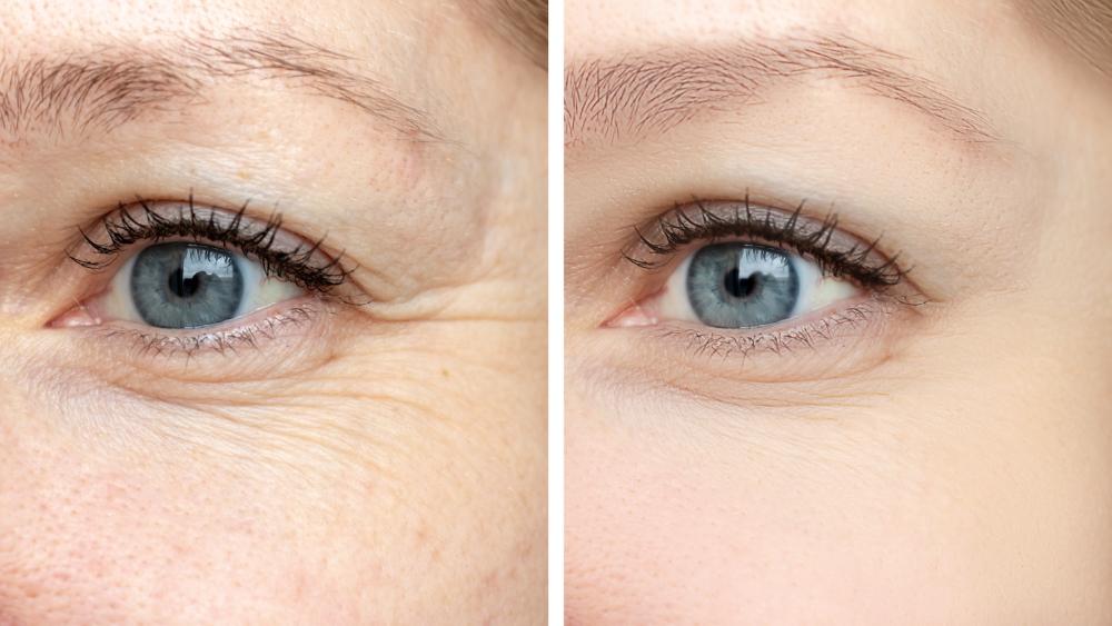 Side-by-side close-up comparison of forehead and eye lines